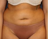 Tummy Tuck 222 - before
