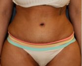 Tummy Tuck 222 - after