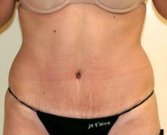 Tummy Tuck Case 7 - after