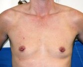 Breast Augmentation Case 40 - before