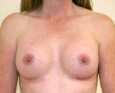 Breast Augmentation Case 40 - after