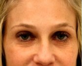 Blepharoplasty Upper/Lower Eyelids 106 - before