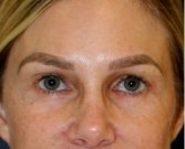 Blepharoplasty Upper/Lower Eyelids 106 - after