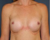 Natural Breast Augmentation 011 - after