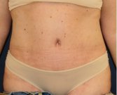 Tummy Tuck 223 - after