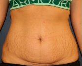 Tummy Tuck 224 - before