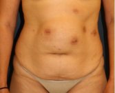 Tummy Tuck 225 - before