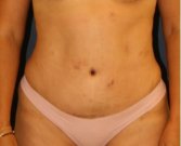 Tummy Tuck 225 - after