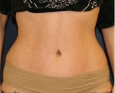 Tummy Tuck 226 - after