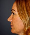 Rhinoplasty 206 - before