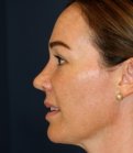 Rhinoplasty 206 - after