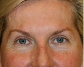 Browlift Case 103 - after