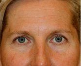 Blepharoplasty Upper Browlift 107 - before