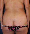 Liposuction Back-Waist 207 - before