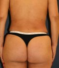 Liposuction Back-Waist 207 - after