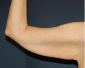 Arm Reduction 208 - before