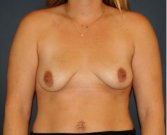 Breast Augmentation Lift 58 - before