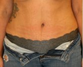 Tummy Tuck 228 - after