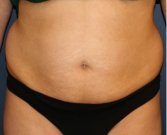Tummy Tuck 229 - before