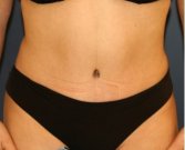 Tummy Tuck 229 - after