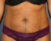 Tummy Tuck 231 - before