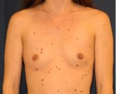Breast Augmentation 143 - before