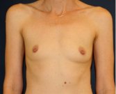 Breast Augmentation 144 - before