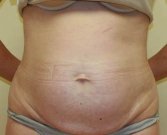 Tummy Tuck Case 25 - before