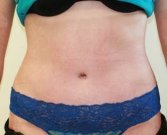 Tummy Tuck Case 25 - after