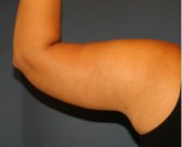 Arm Reduction 209 - after