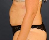 Tummy Tuck 232 - before