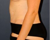 Tummy Tuck 232 - after