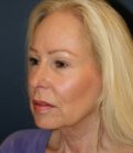 Facelift 103 - before