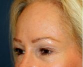 Blepharoplasty 108 - before