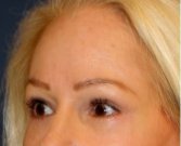 Blepharoplasty 108 - after