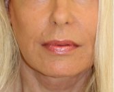 Corner Lip Lift 210 - after