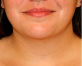Neck Liposuction 208 - before