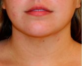Neck Liposuction 208 - after