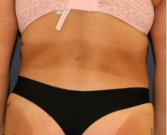 Liposuction Waist-Flanks 209 - after