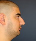 Rhinoplasty 207 - before