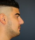 Rhinoplasty 207 - after