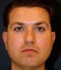 Rhinoplasty 208 - before