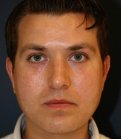 Rhinoplasty 208 - after