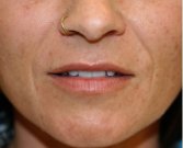 Nasal-Labial Folds Filler 101 - before