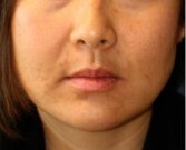 Liposuction Lower Face 210 - before