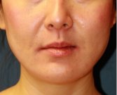 Liposuction Lower Face 210 - after