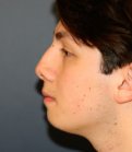 Rhinoplasty 209 - before