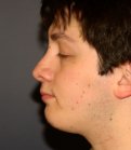 Rhinoplasty 209 - after