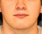 Chin Implant 207 - after