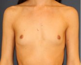 Natural Breast Augmentation 013 - before